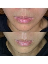 ゴールデンエイジ 吉祥寺(GOLDEN AGE)/ワックス脱毛:施術