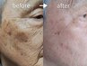 【目立つシミ・モヤモヤシミが気になる方に】最短4ヶ月！シミ改善コース　