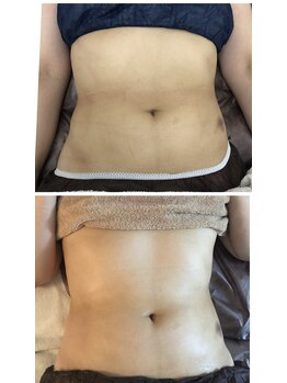 アルページュ(Arpege)/インディバで身体を整える♪