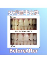 ホワイトニングショップ 西原店/50代前半女性☆BeforeAfter