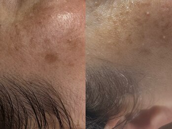 サラグランデ(Sara Grande)/シミケア9回施術