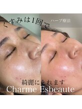 シャルム エスボーテ(charme Esbeaute)/10回のエステより1回のハーブ