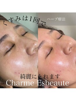 シャルム エスボーテ(charme Esbeaute)/10回のエステより1回のハーブ
