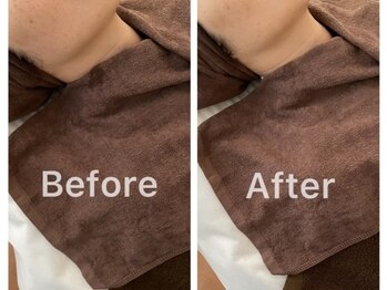 すーりーる/小顔ひきしめコース