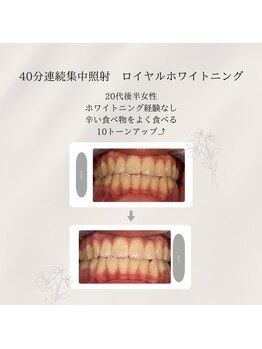 プラスビーセルフ(+b self)/ホワイトニングビフォーアフター