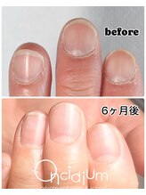 オンシジューム(Oncidium)/自爪育成ネイルケア♪