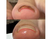 韓国特許取得済み！巻き爪のお悩みお気軽にご相談下さい◎