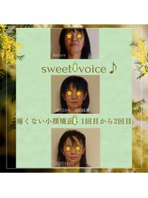 スイートボイス(sweet voice)/小顔矯正ビフォーアフター