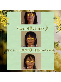 スイートボイス(sweet voice)/小顔矯正ビフォーアフター