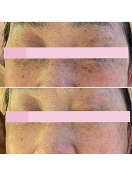 エクシア(ECXIA)/レーザー不可の目元もシミケアで