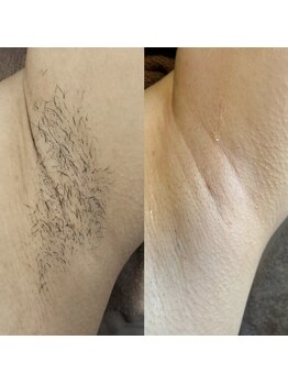 モモ(Momo.)/脱毛4回照射後