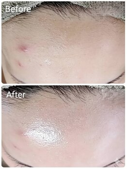 シャルマン/赤み対策ケア特化配合！