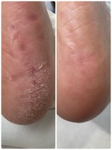 エクラプラス(Eclat.plus)/フットケア