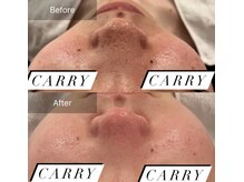 ルネアススパ 南青山(Lune’as Spa)/毛穴の黒ずみ