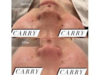 ルネアススパ 南青山(Lune’as Spa)/毛穴の黒ずみ