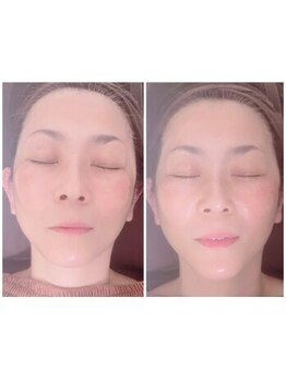 ローカヒ(Lokahi)の写真/セルキュア4Tplusplusで叶える、輝く美肌と感動のリフトアップ体験！◎