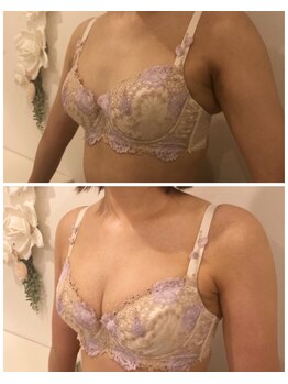 リール 新宿店(RIRE)/40代前半 バストアップ症例