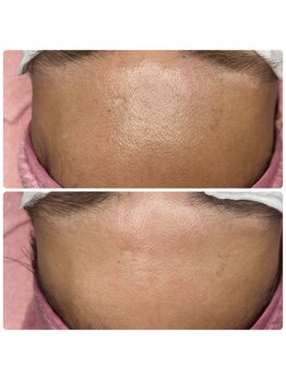 シャルム(Charme)/毛穴肌質改善コース