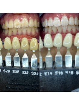 トウキョウスワーズ 池袋店(TOKYO SWRS)/#ホワイトニング #池袋 #渋谷