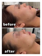 アモ(amo)/BBLフェイシャル直後の変化！