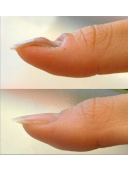 リファーレ(RIFARE)/【深爪矯正】凸凹爪も綺麗に♪