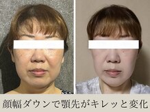 オルビナ(Orbina)/小顔矯正