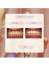 プラスビー 2号店(+b)/ホワイトニングビフォーアフター