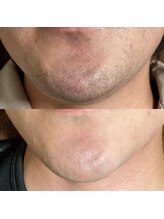 リラチル(relachill)/ヒゲ脱毛