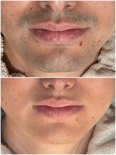 グロー(GLOW)/メンズヒゲ脱毛