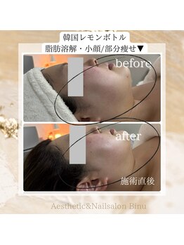 ビヌ(Binu)/脂肪分解レモンボトル・小顔ケア