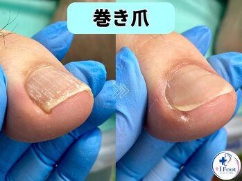 プラスワンフット 本厚木(+1 Foot)/軽い巻き爪でも痛い…