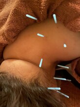 ウララカ(uraraka)/鍼