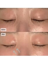 エムベル(M.belle)/リフトアップマッサージ施術前後