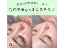 ディエール(Diailes)/肌質改善最強メニュー