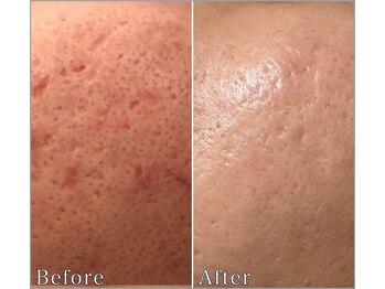 MMK/なめらか肌でハッピーニキビケア