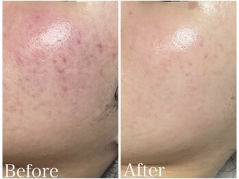 ワイグレイス(Y.GRACE)/マーメイドセルフェイシャル