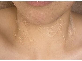 ブリリアンス(BRILLIANCE)/首元のターンオーバーも正常に★