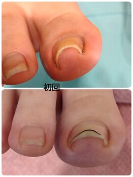 巻き爪ケアワイヤー法