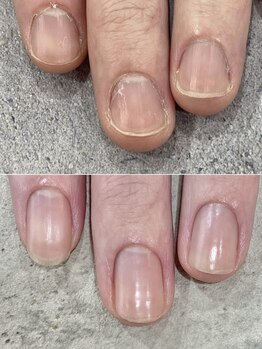 リファーレ(RIFARE)/【深爪矯正】憧れの美爪になれた
