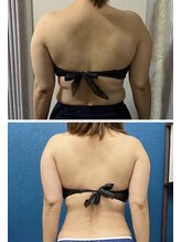 ブランシュムーニー(BRANCHE MOONY)/背中4カップ