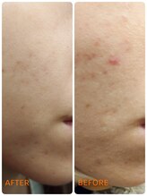 サロン ドゥ メビウス 春日店(salon de mebius)/ハイドラ2回施術　2か月後。。