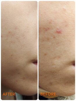 サロン ドゥ メビウス 春日店(salon de mebius)/ハイドラ2回施術 2か月後。。