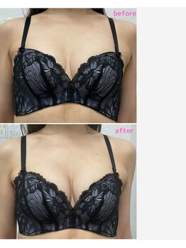 バーディー(BIRDIE)/施術3カ月/3０代/B→D