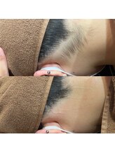 アマリリス(Amaryllis)/うなじシェービング・脱毛