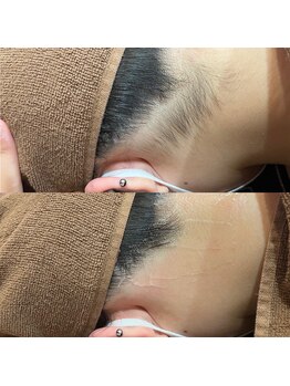 アマリリス(Amaryllis)/うなじシェービング・脱毛