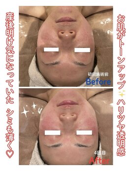 グレッシュ &nbsp;弘前店(Gresh)/WiQO 水光ピールの効果写真