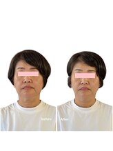 ニコディア(nico-dia)/美容鍼