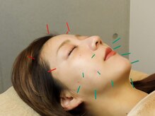 ムラサキ鍼灸治療院(MURASAKI鍼灸治療院)/美容鍼でお悩みスッキリ