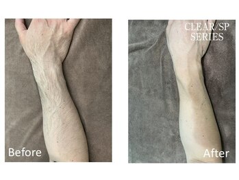 ベルフィオーレ(bel fiore)/メンズ脱毛 腕