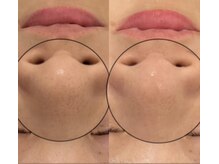 シャルム(CHARME)/REVI陶肌トリートメント